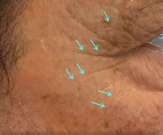 wrinkles_after