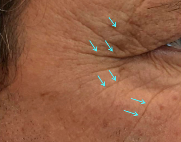 wrinkles_before